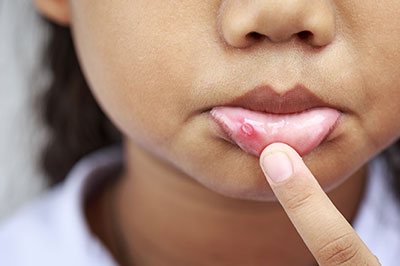 A close-up of a child s hand holding a finger near their mouth, showing a small red spot on the skin.